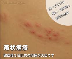 Need to translate 帯状疱疹 (taijōhōshin) from japanese? ç¦å²¡ã§å¸¯çŠ¶ç–±ç–¹ã®æ²»ç™‚ãªã‚‰æ—©è‰¯åŒºã®æ˜Ÿã®åŽŸã‚¯ãƒªãƒ‹ãƒƒã‚¯