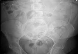 Migration Of Ventriculoperitoneal Shunt To Urethral And Rectal Orifices Bmj Case Reports