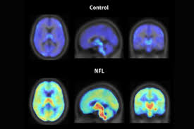 What cte looks like in the brain. Signs Of Brain Injuries In Young Nfl Players Adds To Evidence Linking Concussions Cte Hub