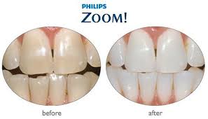 Check spelling or type a new query. Zoom Whitening