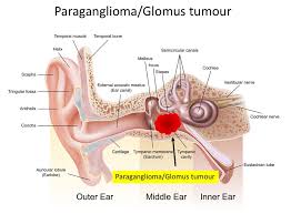 Image result for Glomus tumor