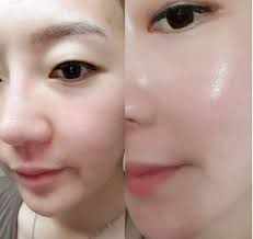 ricopin ビフォーアフター集が凄い 確実に肌を変える再生化粧品効果 イルティン 肌再生mtsプログラム ダーマローラー 肌 たるみ 化粧品