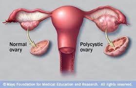 Hair Loss In Women Polycystic Ovarian Syndrome Pcos Dubai Hair Doctor