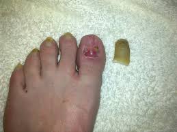Image result for Yellow nail syndrome feet