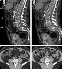 Image result for Helical CT Urogram