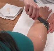 Muscle Scraping | EmergeOrtho