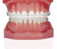 Next, dip the product in cold water for 3 to 5 seconds before putting it in your mouth and biting down lightly. Wearing A Mouthguard With Braces