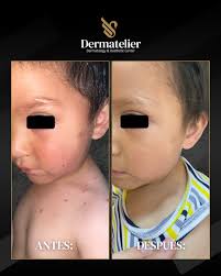 𝐕𝐢𝐬𝐭𝐞 𝐥𝐚𝐬 𝐦𝐚𝐧𝐜𝐡𝐢𝐭𝐚𝐬 𝐛𝐥𝐚𝐧𝐜𝐚𝐬 𝐝𝐞 𝐥𝐚  𝐡𝐢𝐬𝐭𝐨𝐫𝐢𝐚 𝐝𝐞 𝐚𝐲𝐞𝐫? Muchxs votaron… ¡y hoy te cuento la  respuesta! 👇✨ 👉 Si tu hijx tiene manchitas más claras en la cara, brazos  o piernas,