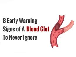 A pulmonary embolism is a blood clot that takes place in the lungs. 8 Early Warning Signs Of A Blood Clot To Never Ignore