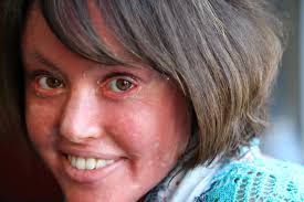 Image result for Ichthyosis