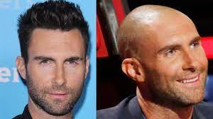 This blog on celebrity hair loss has not been written to make fun of hollywood actors, rock stars, and tv personalities struggling with hair thinning and dealing with it by wearing hair toupees. Celebrity Hair Transplant Transformations Why Shaved Head Doesn T Suit Everybody Youtube