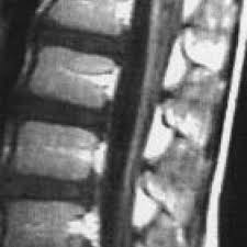 A systematic literature search was performed in pubmed and embase. Guillain Barre Syndrome Eurorad