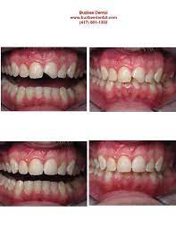This Patient Had An Old Filling That Broke What Is Important To Take Into Consideration When Doing Cosmetic Fillings In The Front Is That You Try T Stomatologiya