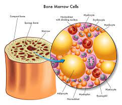 In other people, bone marrow cancer is aggressive. How Multiple Myeloma Of The Spine Is Diagnosed