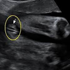 • cadangan scan 4d dilakukan. Gambar Scan Jantina Bayi Perempuan