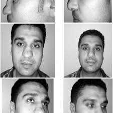 A 47-year-old man with normal evolution of the ESBR after EEA gross...