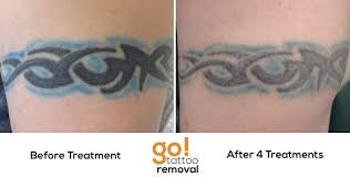 A vlog covering my first laser session to get a tribal tattoo removed. Go Tattoo Removal Lehigh Valley Laser Tattoo Removal Laser Tattoo Removal Tattoos Tattoo Removal