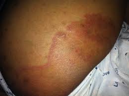 Ketoconazole 1% shampoo is used to treat dandruff. Pin On Beauty Tips