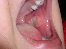 Faq Bitten Lip Discovery Pediatric Dentistry