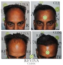 Hair Transplant India Http Www Revivaclinic Com Hair Loss Men Aspx Hair Restoration Hair Transplant Natural Looks