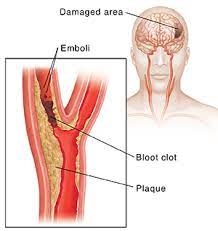 It arises from the bifurcation of the common carotid artery. Carotid Artery Problems Stroke