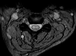 In the acute setting, there is often associated contrast enhancement. Transverse Myelitis Radiology Case Radiopaedia Org