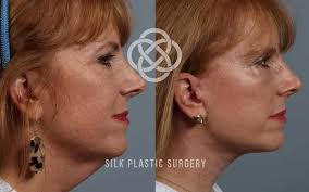 SILK Plastic Surgery