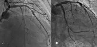 Pyloric stenosis can make a baby vomit forcefully and often. Stenosi Critica Del Ramo Interventricolare Anteriore A Restenosi Download Scientific Diagram