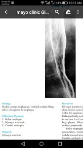 Double Contrast Esophgram Multiple Nodular Filling Defect Glycogen Acanthosis Esophagitis Reflux Esophagitis Radiology
