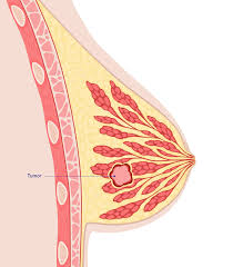 Image result for Breast Cancer