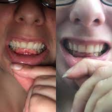 Therefore, you can find by how to fix overbite naturally searching on our tool to know more details. I M Becoming Worried That Invisalign Isn T Doing Anything For My Overbite Left Is Before Treatment Right Is Tray 21 40 Invisalign
