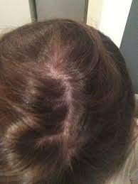 If you have to dye your hair, try using a more natural dye like henna or tea. Chemically Burnt Scalp Will My Hair Regrow Photos