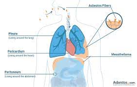 Pleural mesothelioma symptoms include shortness of breath, chest pain, difficulty breathing, malaise, and fatigue. Mesothelioma What Is Malignant Mesothelioma Cancer