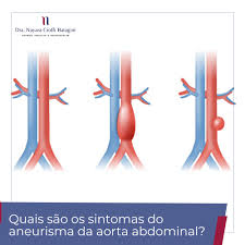 Sintomas is a metalcore music album recording by aneurisma released in 2004 on cd, lp/vinyl aneurisma — sintomas. Quais Os Sintomas Da Aneurisma Da Aorta Abdominal