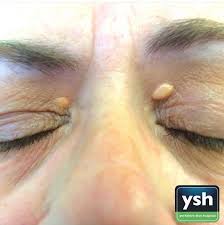 Image result for xanthelasma of eyelid