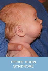 Pierre Robin Syndrome