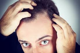 Taking large amounts of vitamin a or selenium is also toxic and can cause hair loss. Teen Hair Loss Hair Centers Inc