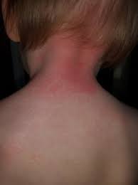 Singapore mum shares about horrible allergic reaction to sunscreen. Toddler Allergic To Sunscreen Babycenter