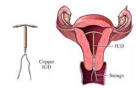 At a peripheral glance to the untrained eye, it could be mistaken for a futuristic tiny boomerang or fancy fishing bait or lure — something that belongs in a tackle box. Global Intrauterine Devices Market 2020 Future Development Bayer Tianyi Allergan Merck Ksu The Sentinel Newspaper