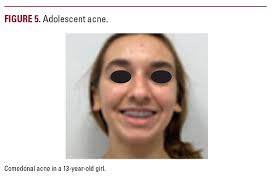 The Many Faces of Pediatric Acne: A Practical Algorithm for Treatment,  Maintenance Therapy, and Skincare Recommendations for Pediatric Acne  Patients
