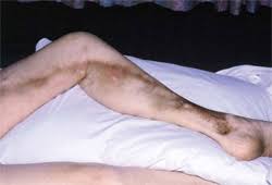 Check spelling or type a new query. Tromboflebitis De La Vena Superficial Sintomas Diagnostico Y Tratamiento Bmj Best Practice