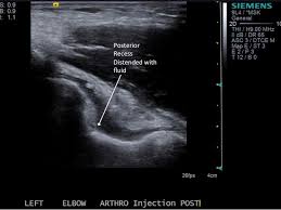 Image result for Elbow Joint Injection