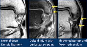 The Radiology Assistant Mri Examination Of The Ankle
