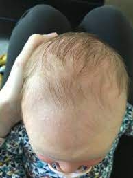 Just like adults, hair loss to a small extent is to be expected in children. Baby Hair Loss My Daughter Looks Like A 80 Year Old Man August 2019 Babies Forums What To Expect
