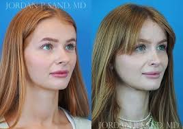 Rhinoplasty 47