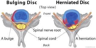 Maybe you would like to learn more about one of these? Herniated Bulging Discs Recharge Sports Injury Center Modern Chiropractic Care