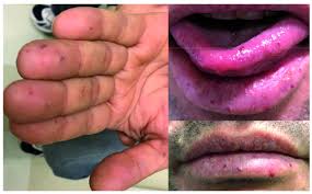 Hereditary Hemorrhagic Telangiectasia Diagnosis And Management From The Hematologist S Perspective Haematologica