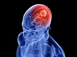 What happens to your brain when you have a seizure. 6 Brain Tumor Warning Signs You Should Know Mather Hospital