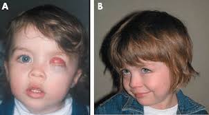 Facial appearance of patient with left microphthalmia and cyst showing...