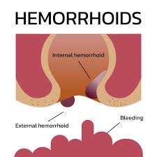 Image result for Hemorrhoid